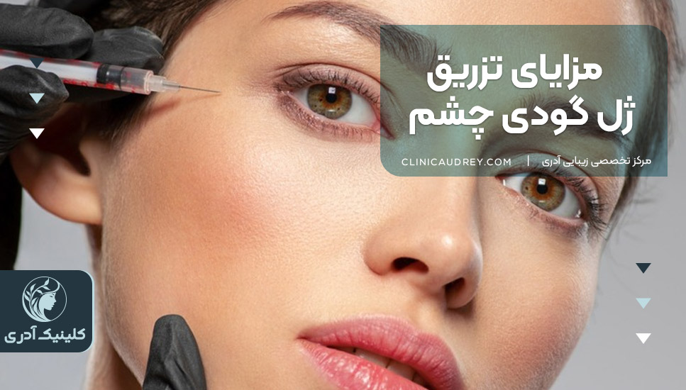 مزایای تزریق ژل گودی چشم 