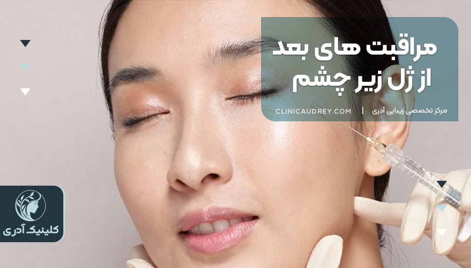 مراقبت های بعد از ژل زیر چشم