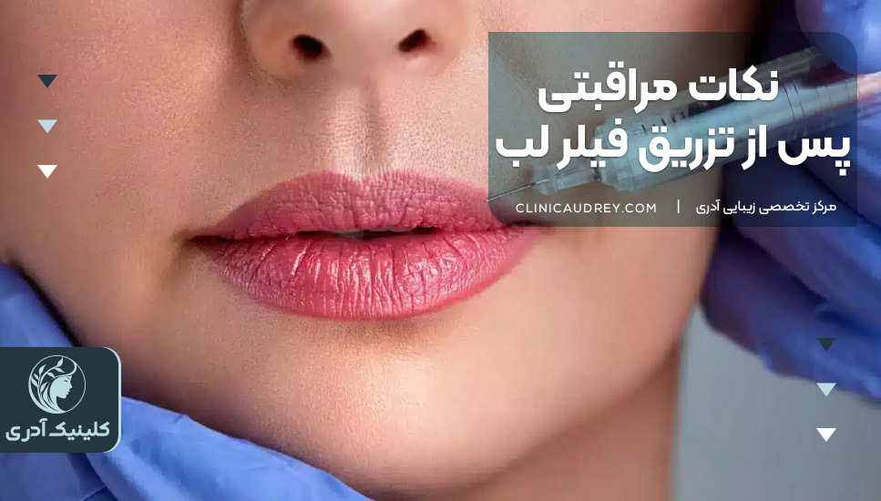 نکات مراقبتی پس از تزریق فیلر لب