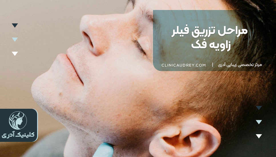 مراحل تزریق فیلر زاویه فک