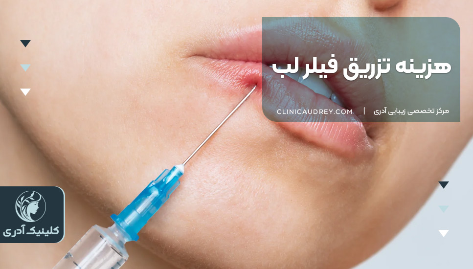 هزینه تزریق فیلر لب