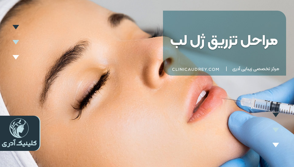 مراحل تزریق ژل لب