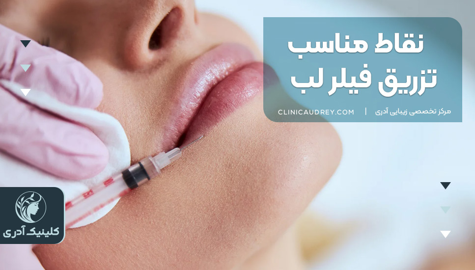 نقاط مناسب تزریق فیلر لب