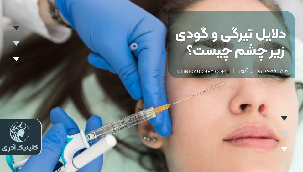 دلایل تیرگی و گودی زیر چشم چیست؟ 