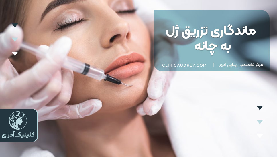 ماندگاری تزریق ژل به چانه