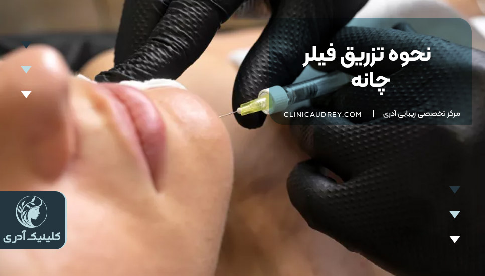 نحوه تزریق فیلر چانه