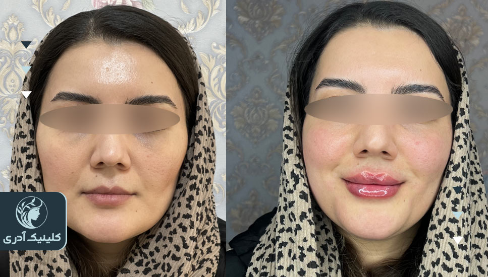 تصاویر قبل و بعد از تزریق فیلر لب