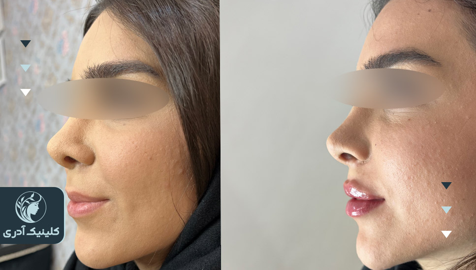 تصاویر قبل و بعد از تزریق فیلر لب