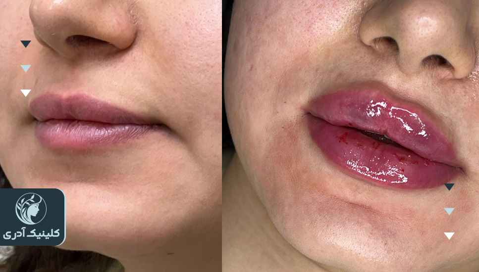 تصاویر قبل و بعد از تزریق فیلر لب