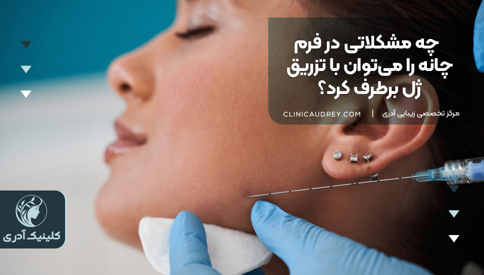چه مشکلاتی در فرم چانه را میتوان با تزریق ژل برطرف کرد؟