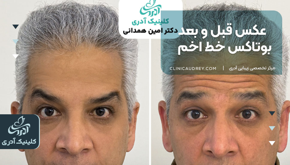 عکس قبل و بعد بوتاکس خط اخم