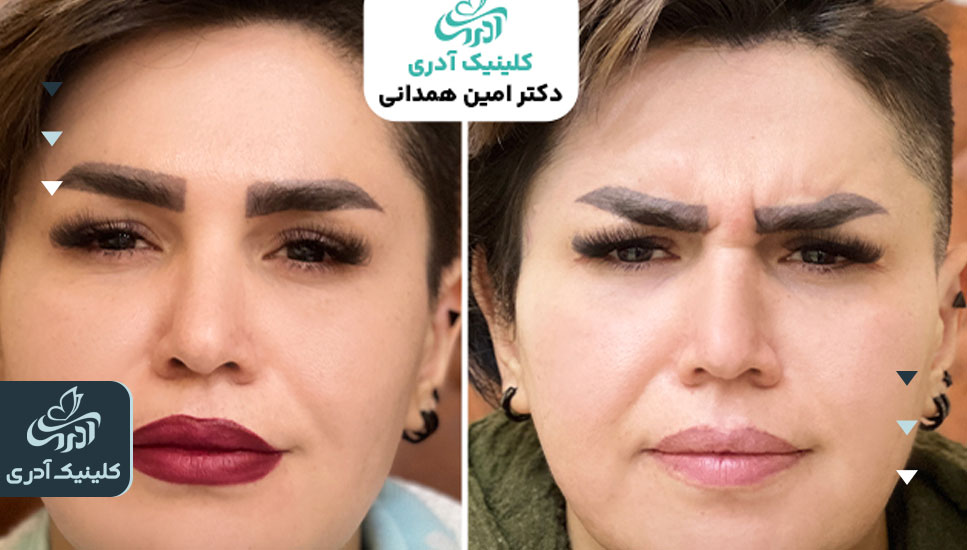 عکس قبل و بعد بوتاکس خط اخم