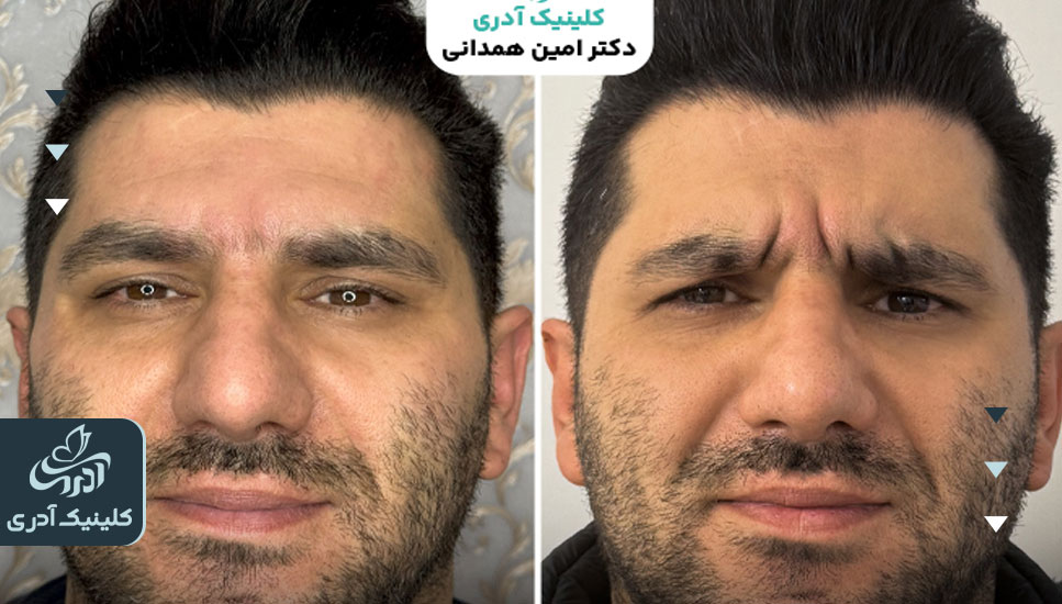عکس قبل و بعد بوتاکس خط اخم
