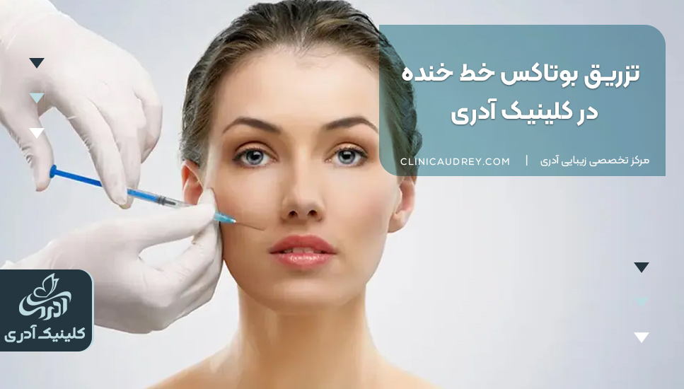 تزریق بوتاکس خط خنده در کلینیک آدری