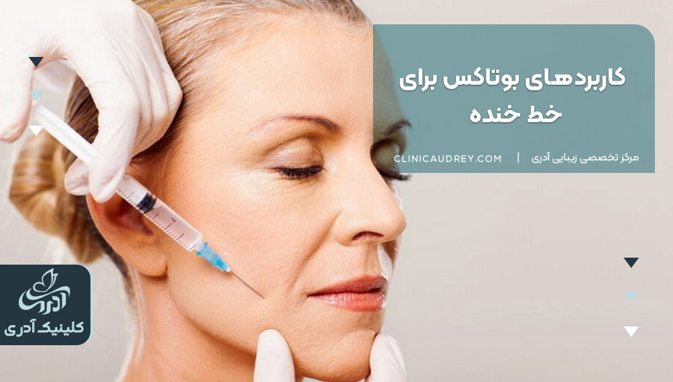 کاربردهای بوتاکس برای خط خنده