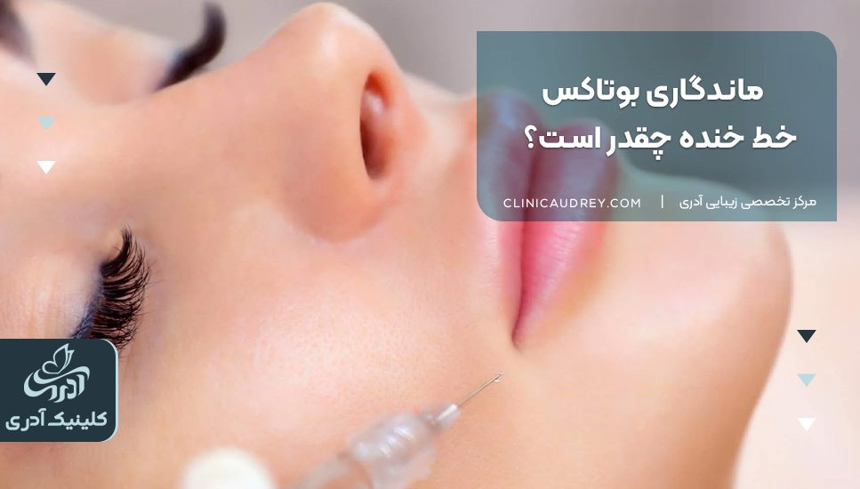 بوتاکس خط خنده چقدر ماندگاری دارد؟