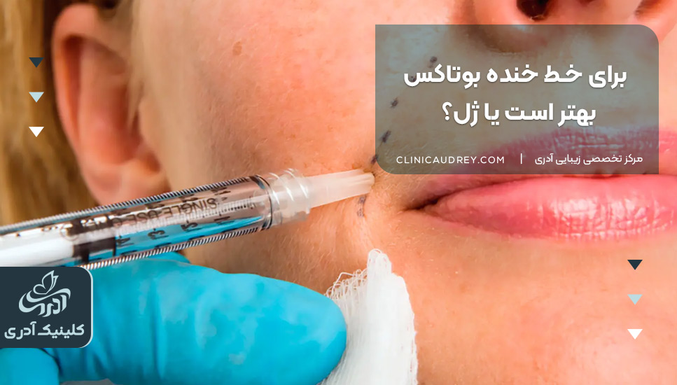 برای خط خنده بوتاکس بهتره یا ژل؟