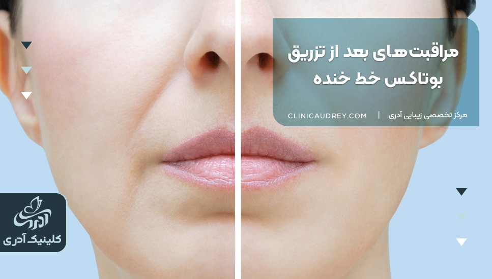 مراقبتهای بعد از تزریق بوتاکس خط خنده