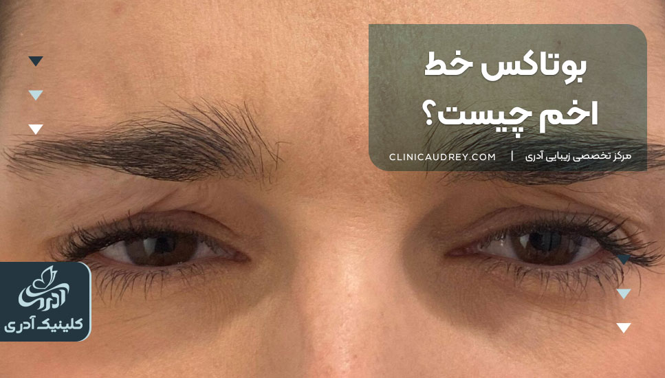 بوتاکس خط اخم چیست؟
