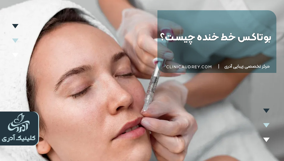بوتاکس خط خنده چیست؟