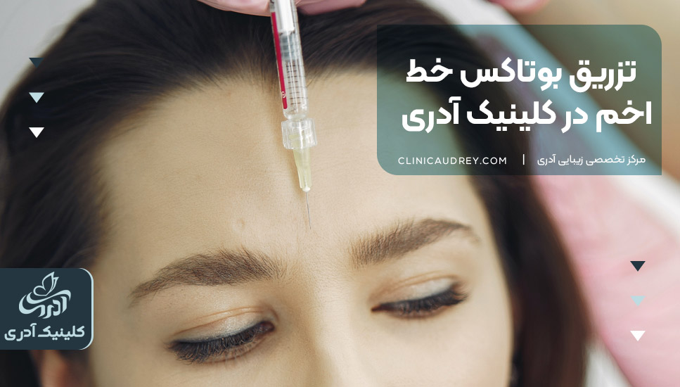 تزریق بوتاکس خط اخم در کلینیک آدری