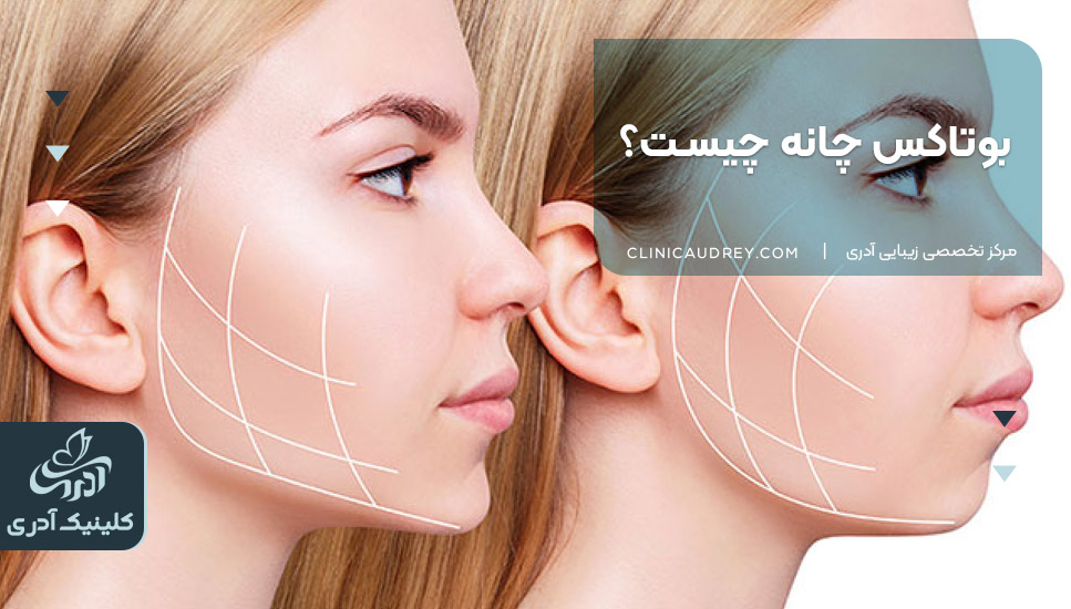  بوتاکس چانه چیست؟