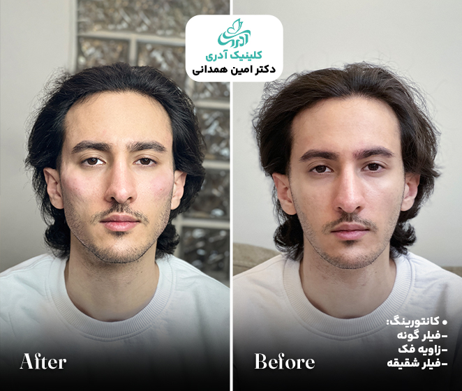 نمونه کار فیلر گونه