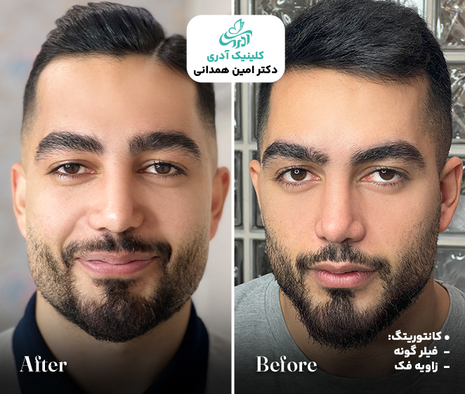 نمونه کار کانتورینگ صورت