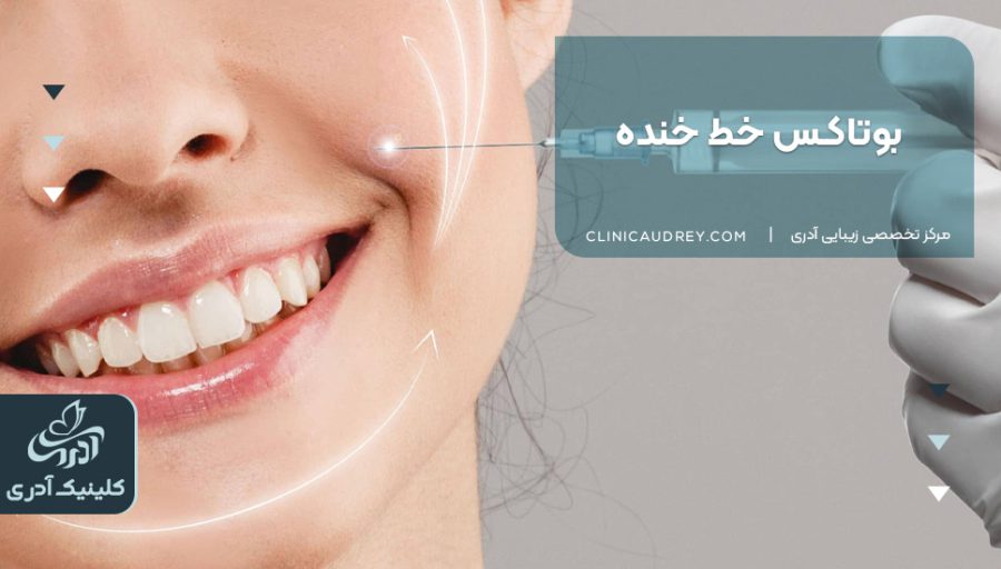 بوتاکس خط خنده |مزایا و کاربردهای بوتاکس خط خنده[هزینه 1404]